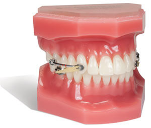 Palatal Expander - part of orthodontic treatment at Soleil