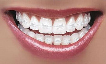 Clear Braces a the Orthodontists office of Soleil Orthodontics