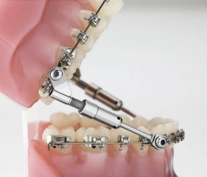 Palatal Expander - part of orthodontic treatment at Soleil Orthodontics