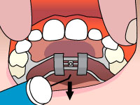 Palatal Expander