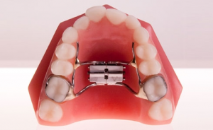 Palatal Expander - part of orthodontic treatment at Soleil