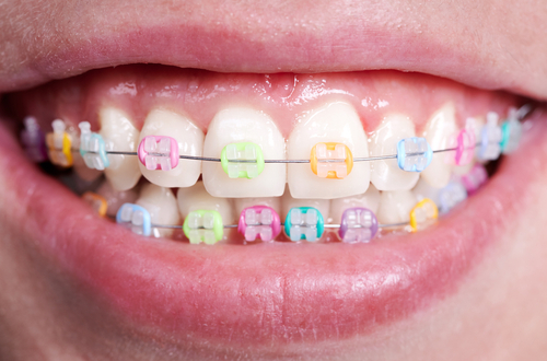 Braces Colours - Show off your personality with colour!