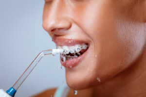 keeping your braces clean soleil orthodontics