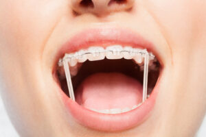 rubber bands elastics braces soleil orthodontics